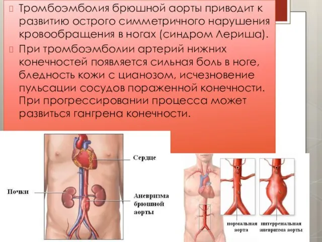 Тромбоэмболия брюшной аорты приводит к развитию острого симметричного нарушения кровообращения в ногах