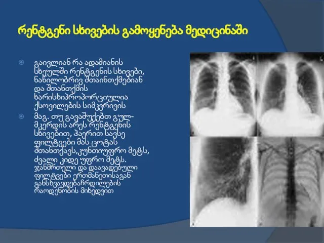 რენტგენი სხივების გამოყენება მედიცინაში გაივლიან რა ადამიანის სხეულში რენტგენის სხივები, ნაწილობრივ შთაინთქმებიან