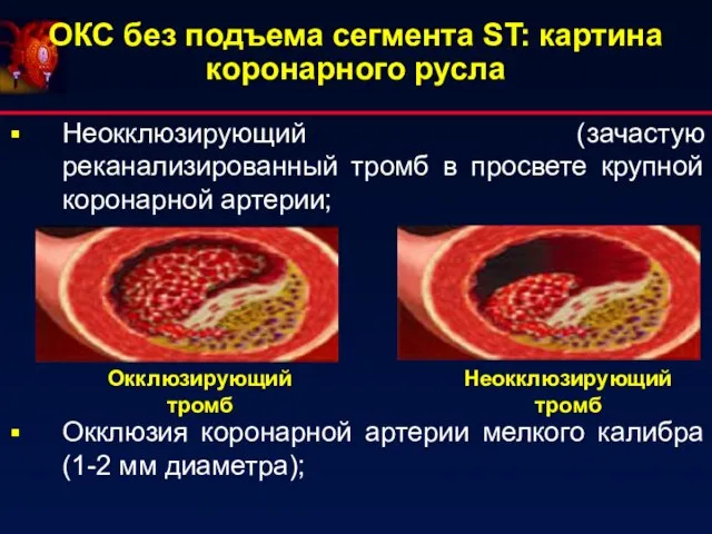 ОКС без подъема сегмента ST: картина коронарного русла Неокклюзирующий (зачастую реканализированный тромб