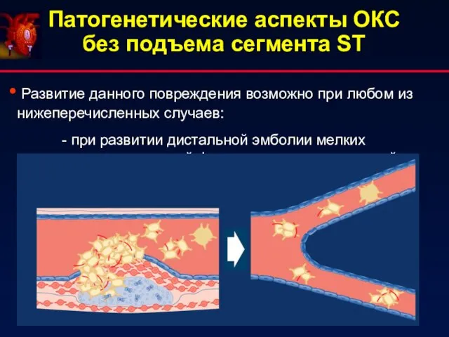 Патогенетические аспекты ОКС без подъема сегмента ST Развитие данного повреждения возможно при