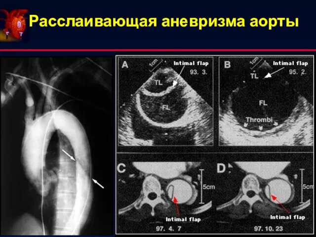 Расслаивающая аневризма аорты