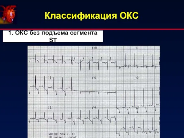 Классификация ОКС 1. ОКС без подъема сегмента ST