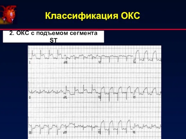 Классификация ОКС 2. ОКС с подъемом сегмента ST