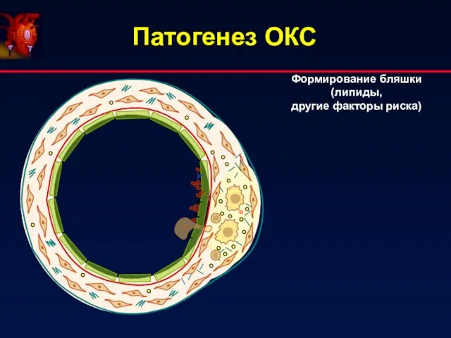 Патогенез ОКС Формирование бляшки (липиды, другие факторы риска)