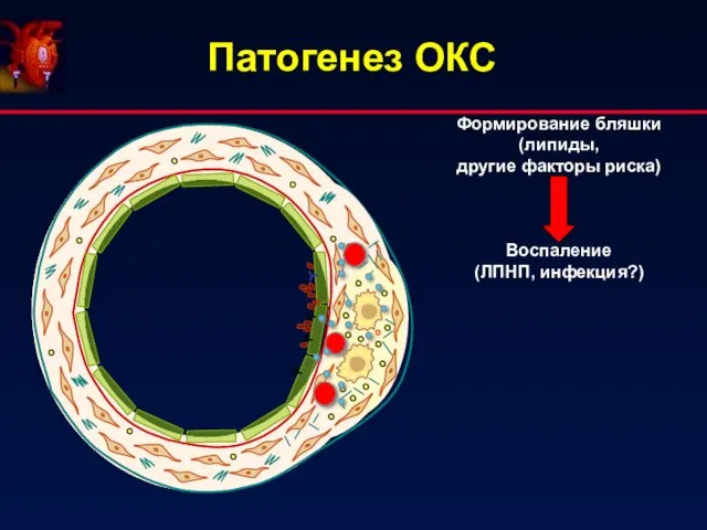 Патогенез ОКС Формирование бляшки (липиды, другие факторы риска) Воспаление (ЛПНП, инфекция?)