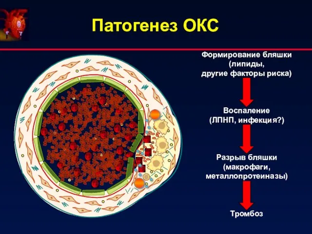 Патогенез ОКС Формирование бляшки (липиды, другие факторы риска) Воспаление (ЛПНП, инфекция?) Разрыв бляшки (макрофаги, металлопротеиназы) Тромбоз