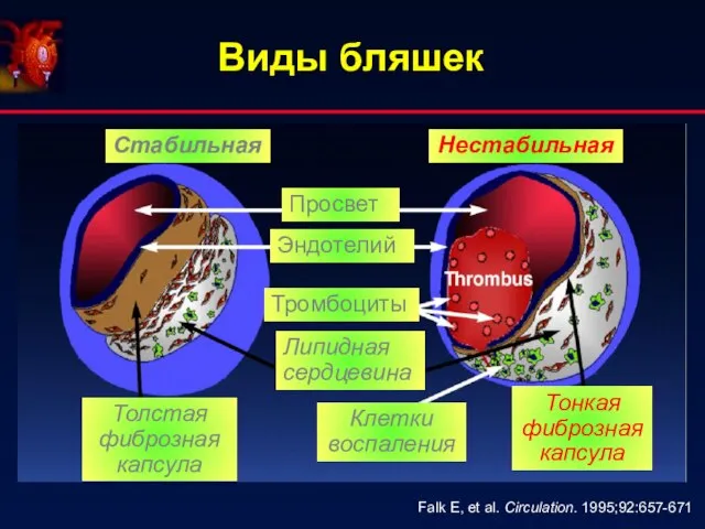 Виды бляшек Falk E, et al. Circulation. 1995;92:657-671 Стабильная Нестабильная Толстая фиброзная