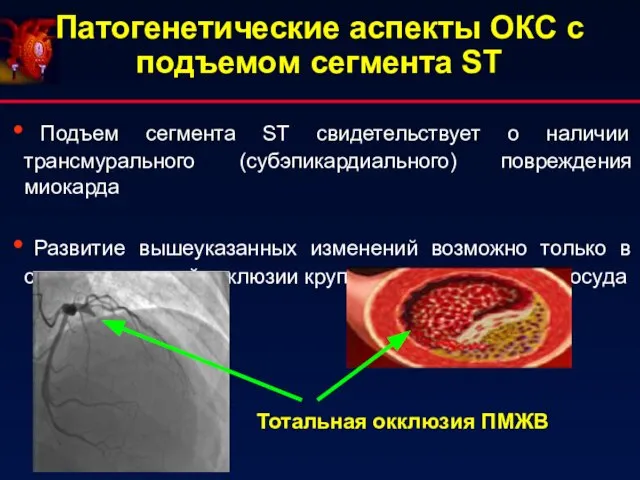 Патогенетические аспекты ОКС с подъемом сегмента ST Подъем сегмента ST свидетельствует о