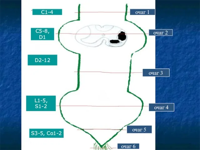 C1-4 С5-8, D1 D2-12 L1-5, S1-2 S3-5, Co1-2 очаг 1 очаг 2