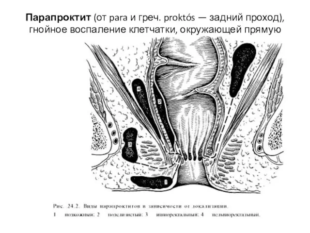 Парапроктит (от para и греч. proktós — задний проход), гнойное воспаление клетчатки, окружающей прямую кишку.