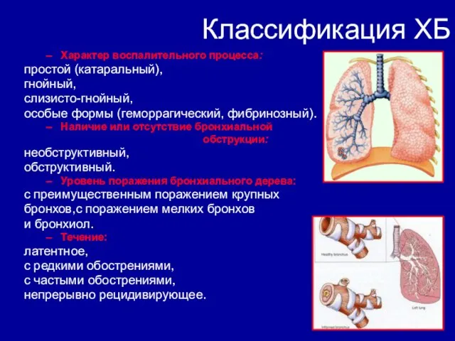 Классификация ХБ Характер воспалительного процесса: простой (катаральный), гнойный, слизисто-гнойный, особые формы (геморрагический,