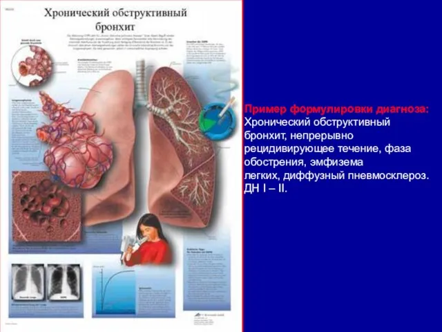 Пример формулировки диагноза: Хронический обструктивный бронхит, непрерывно рецидивирующее течение, фаза обострения, эмфизема