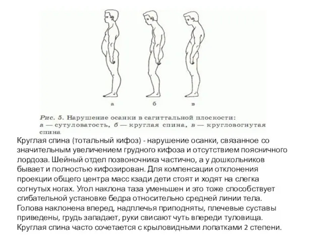 Круглая спина (тотальный кифоз) - нарушение осанки, связанное со значительным увеличением грудного