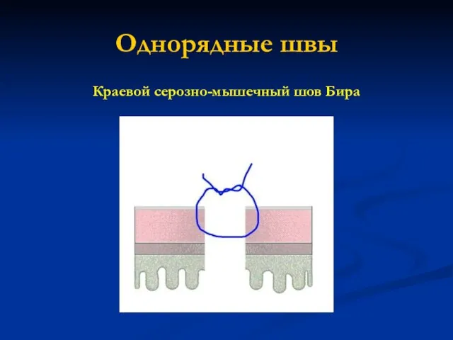 Однорядные швы Краевой серозно-мышечный шов Бира