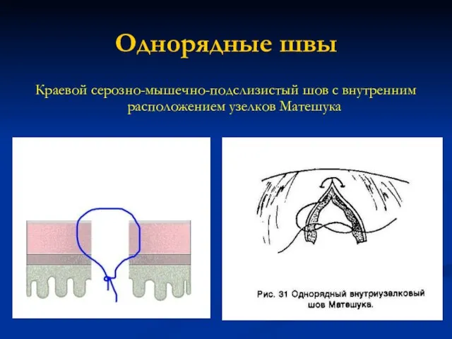 Однорядные швы Краевой серозно-мышечно-подслизистый шов с внутренним расположением узелков Матешука