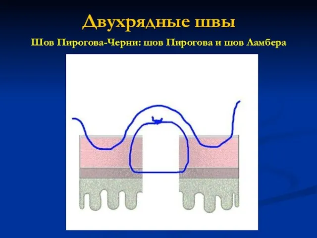 Двухрядные швы Шов Пирогова-Черни: шов Пирогова и шов Ламбера