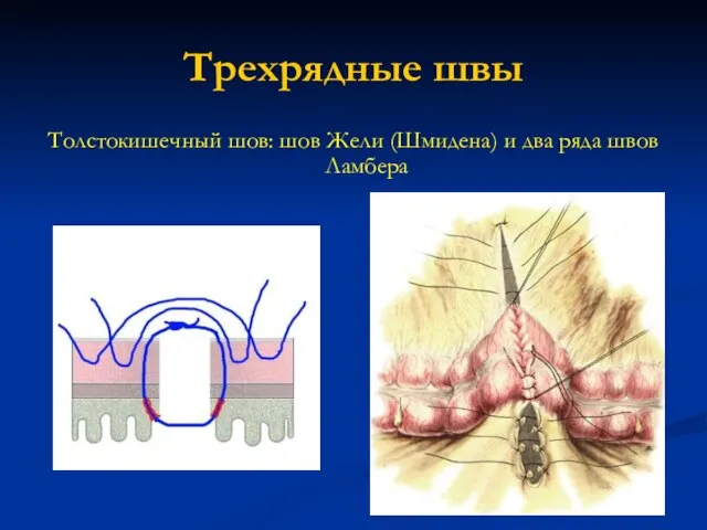 Трехрядные швы Толстокишечный шов: шов Жели (Шмидена) и два ряда швов Ламбера