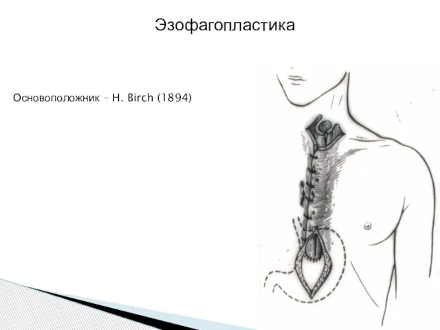 Эзофагопластика Основоположник – H. Birch (1894)