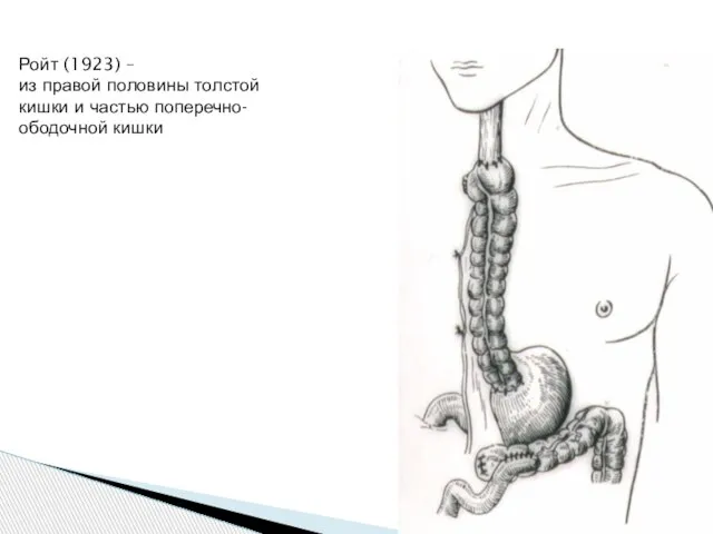 Ройт (1923) – из правой половины толстой кишки и частью поперечно- ободочной кишки