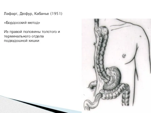 Лафарг, Дюфур, Кабанье (1951) «Бордосский метод» Из правой половины толстого и терминального отдела подвздошной кишки
