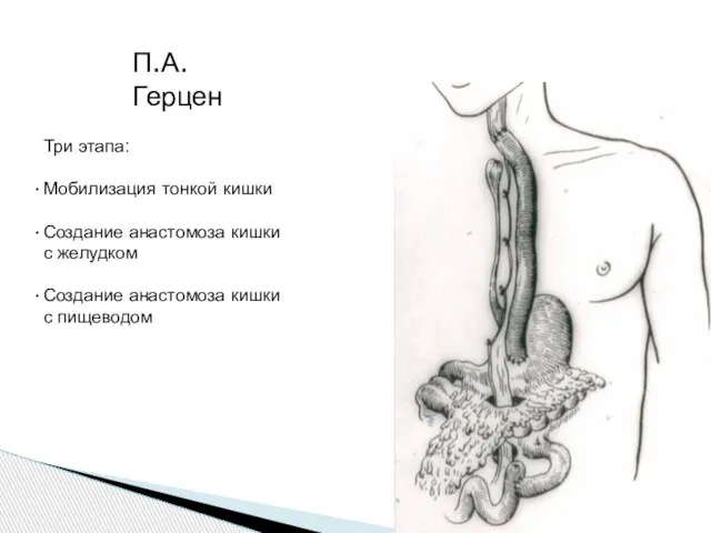 П.А. Герцен Три этапа: Мобилизация тонкой кишки Создание анастомоза кишки с желудком
