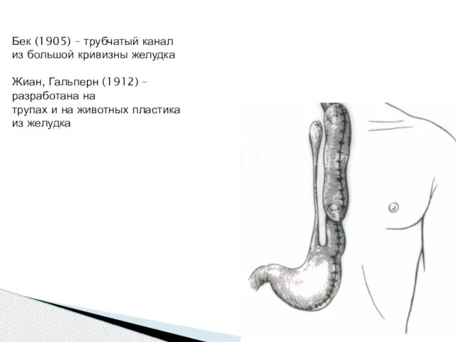 Бек (1905) – трубчатый канал из большой кривизны желудка Жиан, Гальперн (1912)