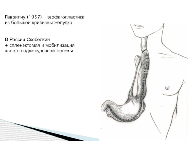 Гаврилиу (1957) – эзофагопластика из большой кривизны желудка В России Скобелкин +
