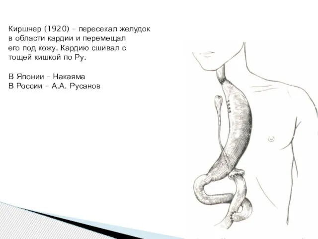 Киршнер (1920) – пересекал желудок в области кардии и перемещал его под