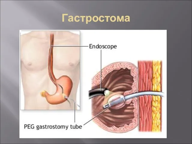 Гастростома