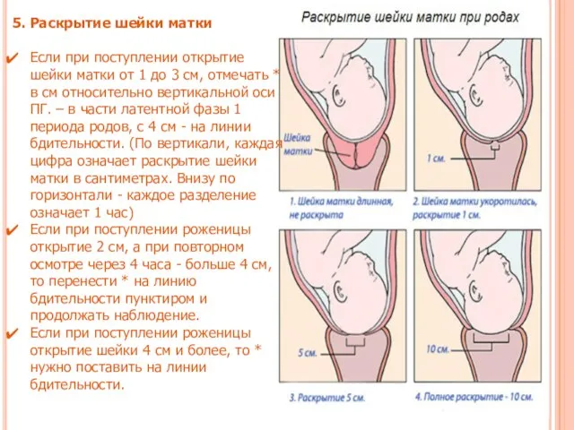 5. Раскрытие шейки матки Если при поступлении открытие шейки матки от 1