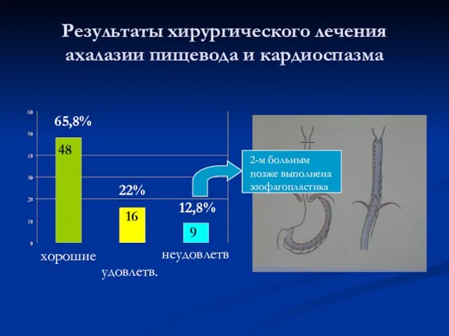 Результаты хирургического лечения ахалазии пищевода и кардиоспазма 2-м больным позже выполнена эзофагопластика