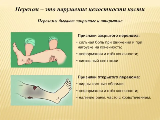 Перелом – это нарушение целостности кости Переломы бывают закрытые и открытые Признаки