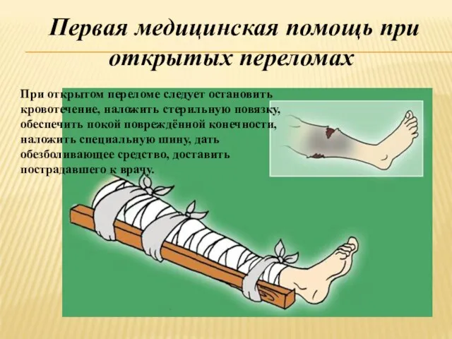 Первая медицинская помощь при открытых переломах При открытом переломе следует остановить кровотечение,