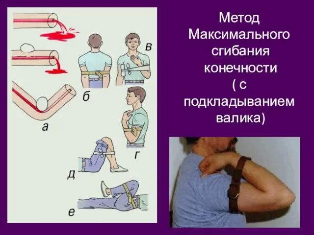 Метод Максимального сгибания конечности ( с подкладыванием валика)