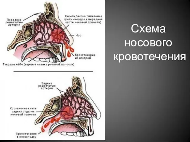 Схема носового кровотечения