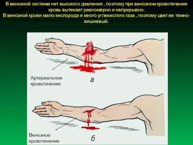 В венозной системе нет высокого давления , поэтому при венозном кровотечении кровь