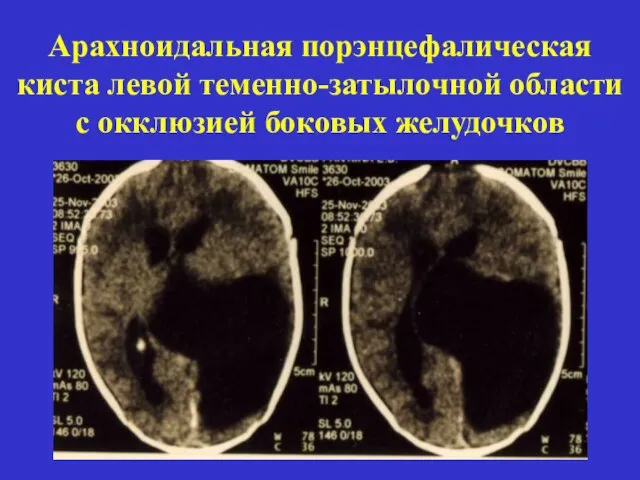 Арахноидальная порэнцефалическая киста левой теменно-затылочной области с окклюзией боковых желудочков