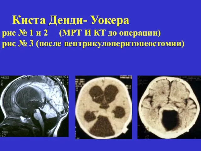 Киста Денди- Уокера рис № 1 и 2 (МРТ И КТ до