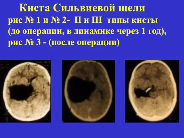 Киста Сильвиевой щели рис № 1 и № 2- II и III