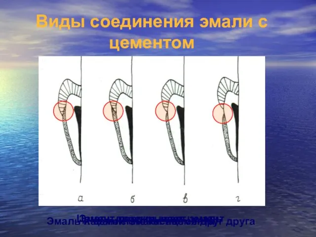 Эмаль перекрывает цемент Цемент перекрывает эмаль Касание эмали ицемента Эмаль и цемент