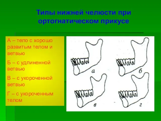 Типы нижней челюсти при ортогнатическом прикусе А – тело с хорошо развитым