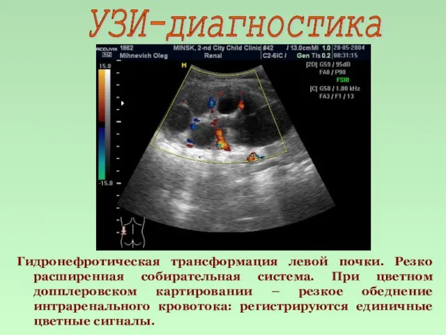 УЗИ-диагностика Гидронефротическая трансформация левой почки. Резко расширенная собирательная система. При цветном допплеровском