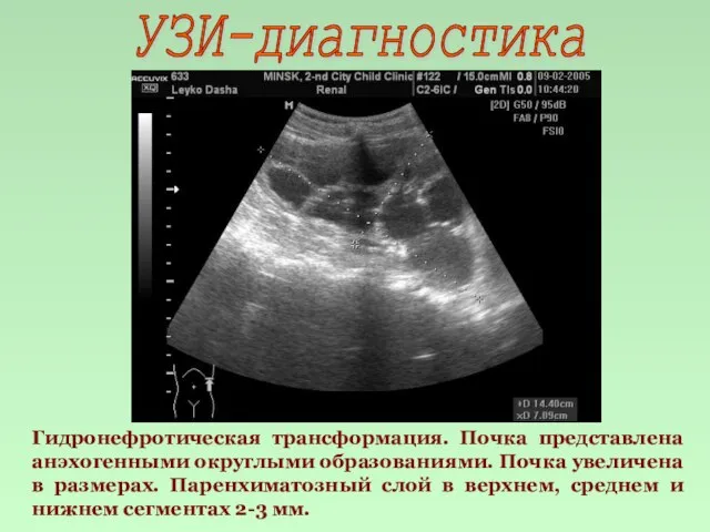 УЗИ-диагностика Гидронефротическая трансформация. Почка представлена анэхогенными округлыми образованиями. Почка увеличена в размерах.