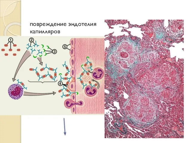 повреждение эндотелия капилляров