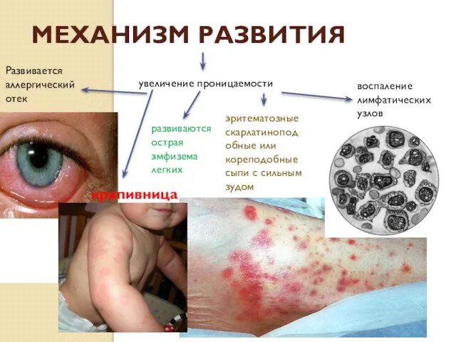 Механизм развития увеличение проницаемости Развивается аллергический отек крапивница развиваются острая эмфизема легких