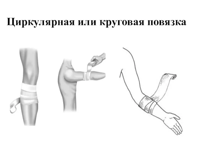 Циркулярная или круговая повязка