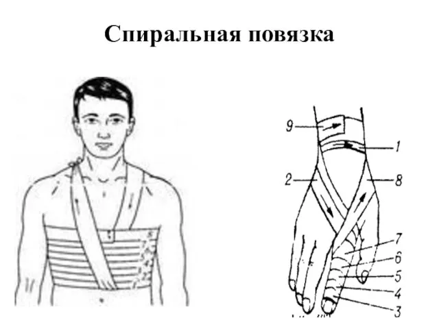 Спиральная повязка