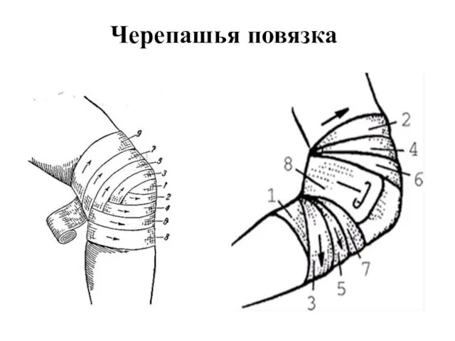 Черепашья повязка