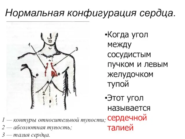 Нормальная конфигурация сердца. 1 — контуры относительной тупости; 2 — абсолютная тупость;