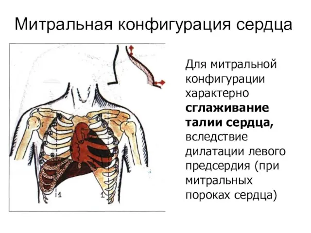 Митральная конфигурация сердца Для митральной конфигурации характерно сглаживание талии сердца, вследствие дилатации